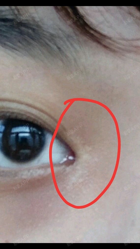 我的内眼角的疤痕特别明显,而且很大,属于白色疤痕,