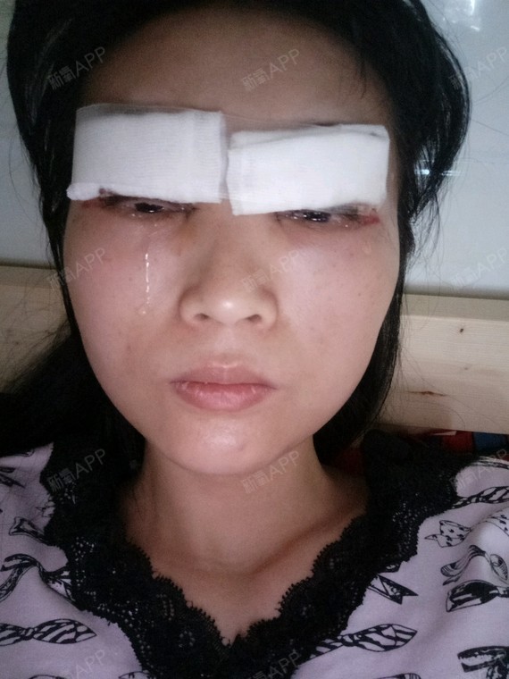 眼睛已经肿成一条缝了