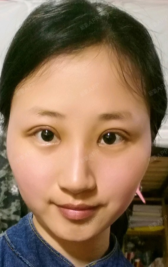 术前我的眼睛是小内双,两只眼轻微不对称,就连眼角以及脂肪厚薄程度都
