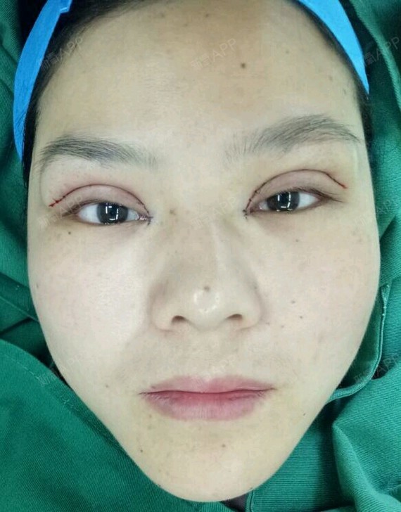 北京切开双眼皮好不好_效果图_你好戴安娜切开双眼皮术后第0天_新氧