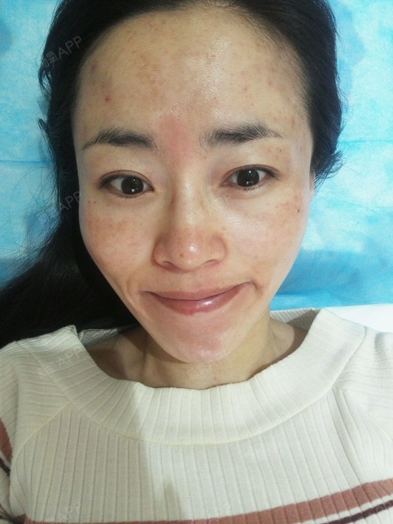 北京镭射净肤好不好_效果图_iris_minnie镭射净肤术后第0天_新氧美容