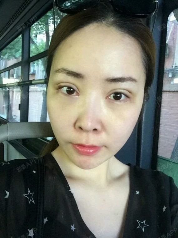亲爱的宝宝们,这是我做完内吸眼袋的第一周,是不是已_圈子-新氧美容