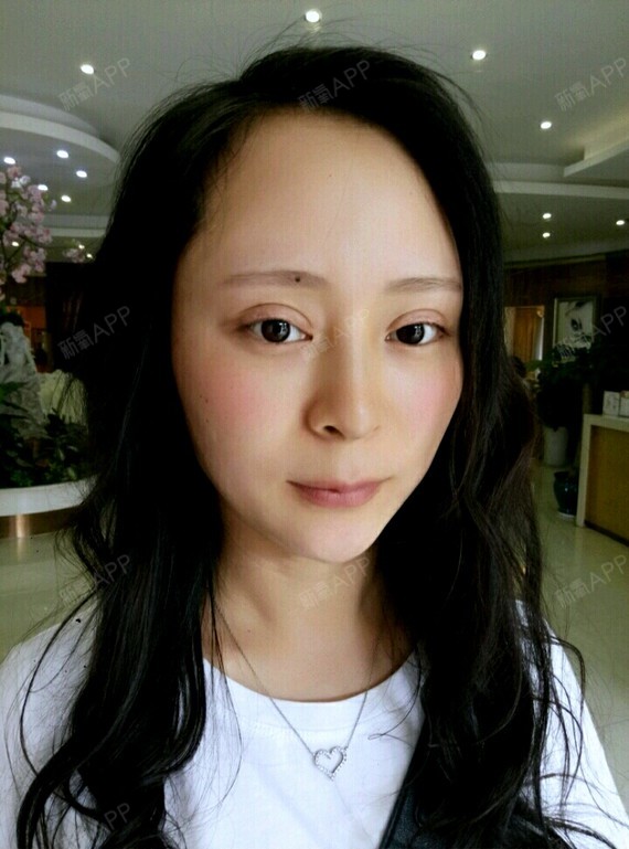 做完线雕鼻第三天鼻子的淤青就消了,把胶布撕下来看着_圈子-新氧美容
