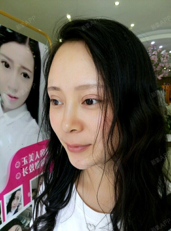 做完线雕鼻第三天鼻子的淤青就消了,把胶布撕下来看着_圈子-新氧美容