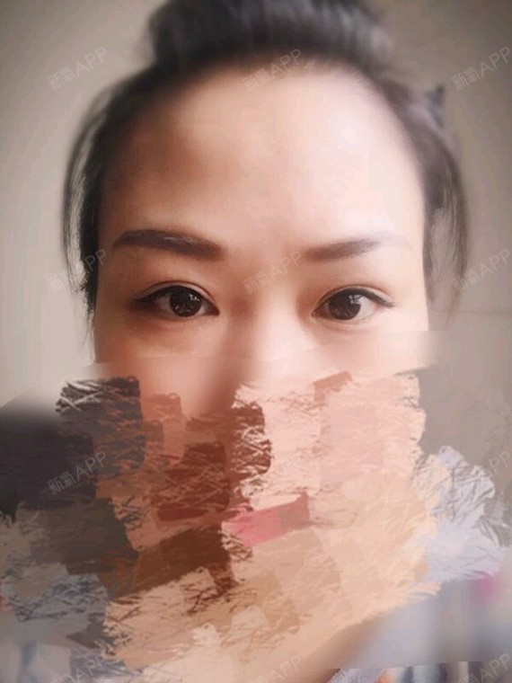 【北京来美安王振军上睑下垂再矫正】