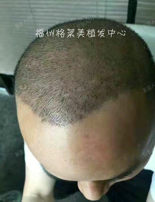 南昌格莱美植发地址(南昌哪家医院植发最好)