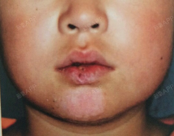 婴儿嘴唇血管瘤图片