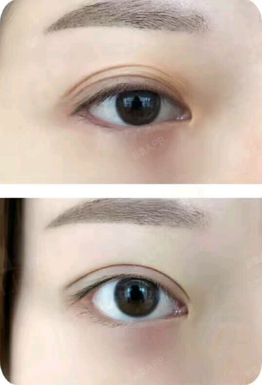 上眼皮松弛多眼皮,通过全切双眼皮 上眼皮去脂 提升矫正.