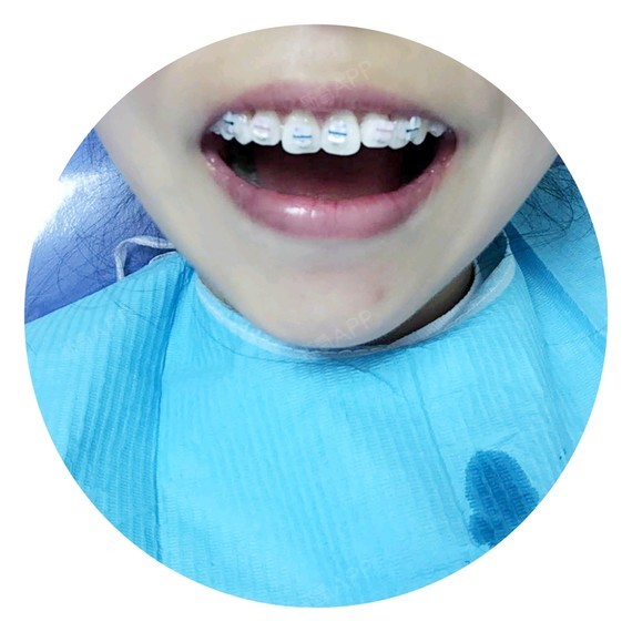 第二天上午又去医院看片子和模型,柴医生说我有一