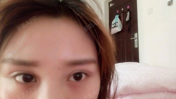 双眼皮纳米无痕恢复了大概一个月了,瞪着眼睛照是这样_圈子-新氧美容