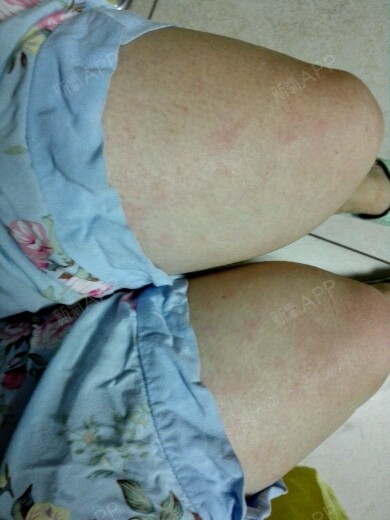 31号打完肉毒素回来今天脸部过敏,手,大腿,都出红_圈子-新氧美容整形