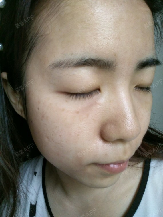 激光祛斑好不好_效果图_小萌萌zz激光祛斑术后第1天_新氧美容整形