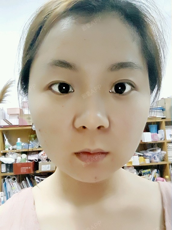 我的鼻子有点扁平没有山根所以整个人比较没有气质希望_圈子-新氧美容