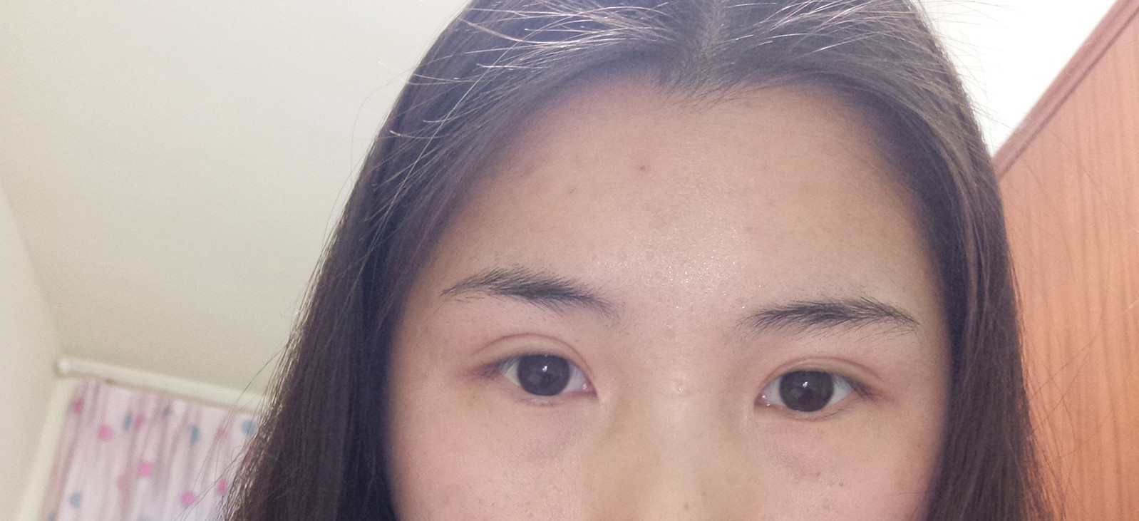 内切去眼袋怎么样_恢复过程_效果如何_氧气J