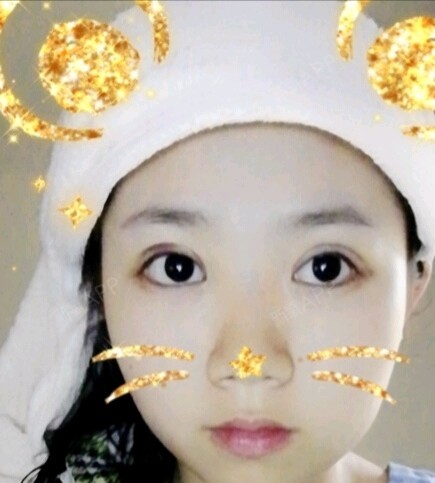 12322定点双眼皮第7天美丽日记