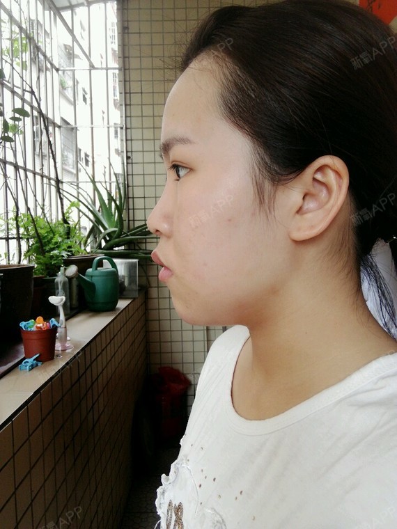 上周打了溶解酶之后下巴一直挺疼的又疼又肿摸着还是硬_圈子-新氧美容