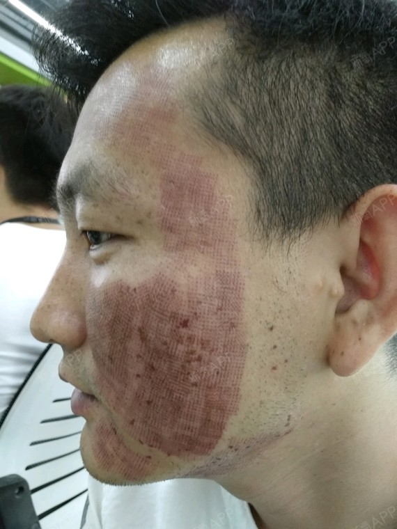 激光美肤 | 术后当自强 | 北京同城 | 护肤 | 激光祛痘祛痘印