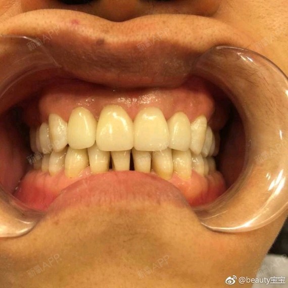 【黑三角科普】大多是因为牙齿矫正之后出现的,细细总结起来,黑三角的