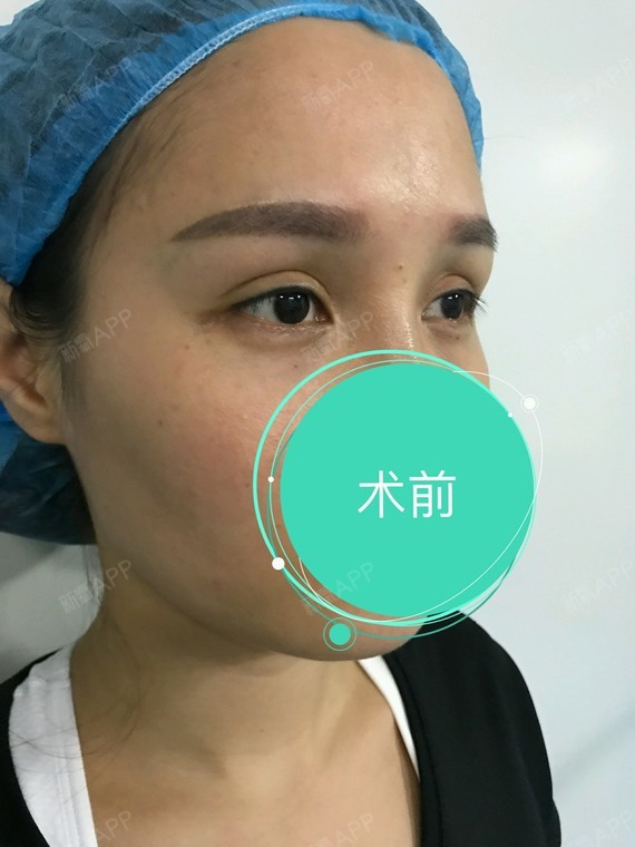 洁小杰切开双眼皮第0天美丽日记