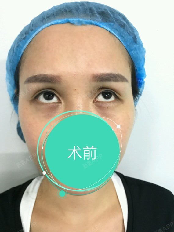 眼睛做过几次,这次做的是自体脂肪填充上眼皮处,第一_圈子-新氧美容