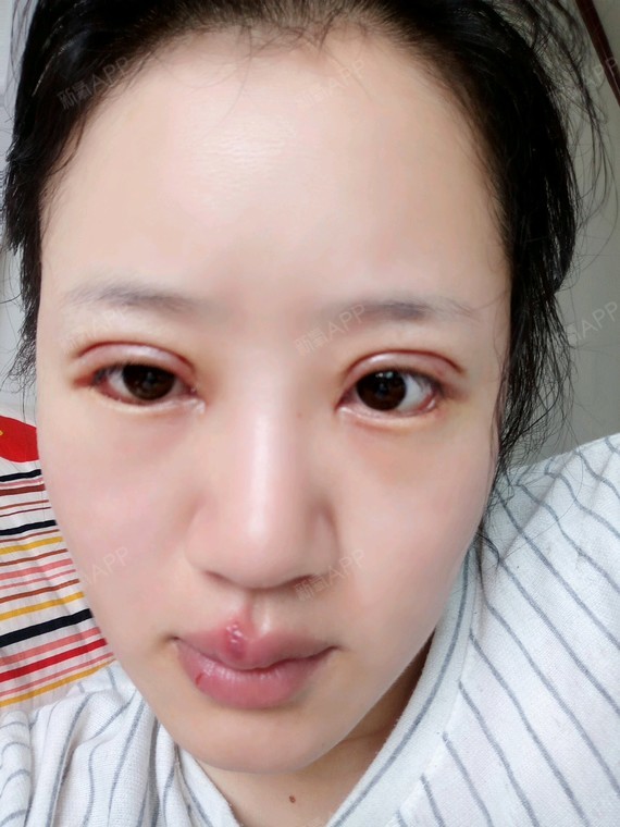 成都眼部多项好不好_效果图_ada喵眼部多项术后第10天_新氧美容整形