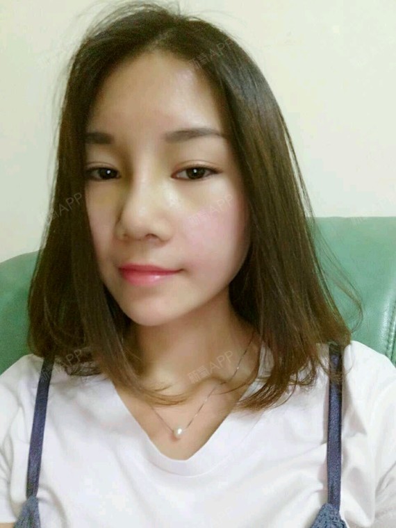 蝶儿恋花硅胶隆鼻第7天美丽日记