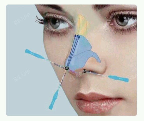 【长沙美莱-线雕】