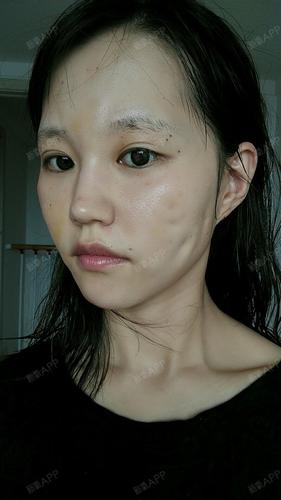 氧气8223431487920277埋线提升第3天美丽日记-新氧美容整形