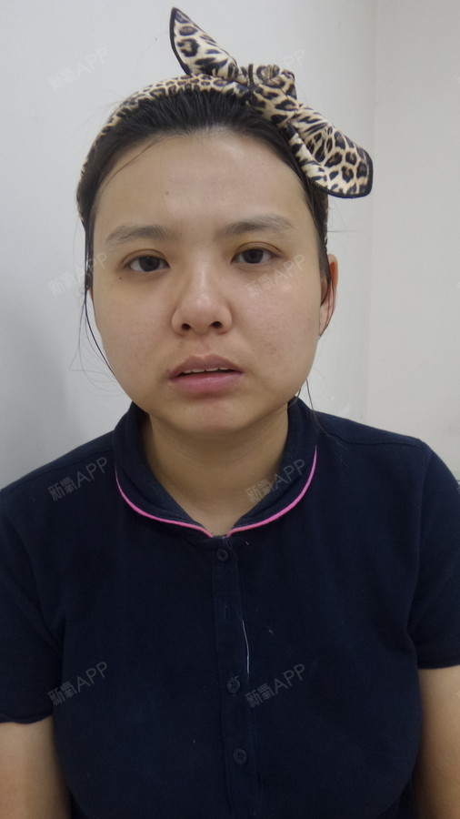 虽然没有网红那样有双欧式平行眼,但我也可以鱼目混珠_圈子-新氧美容