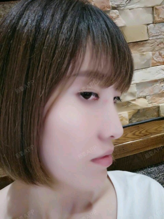 v-line瓜子脸手术好不好_效果图_菲菲爱分享v-line瓜子脸手术术后第70