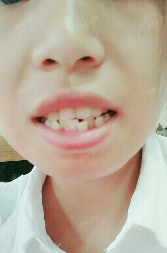 我是属于上面牙齿包下面的牙齿,牙齿也不是很整齐,下_圈子-新氧美容