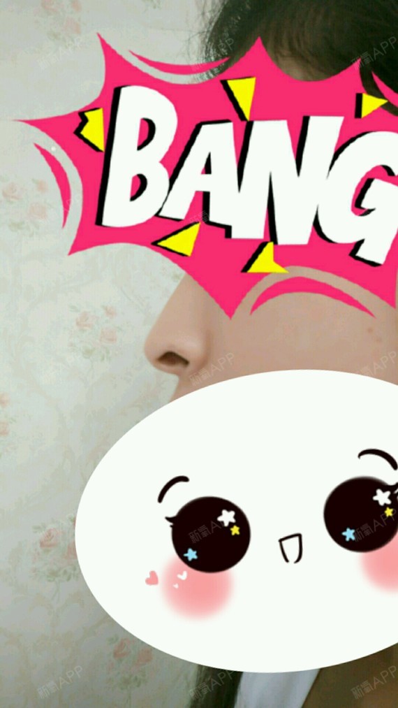 本人鼻子鼻翼缘后缩,所以鼻孔看起来很大。医