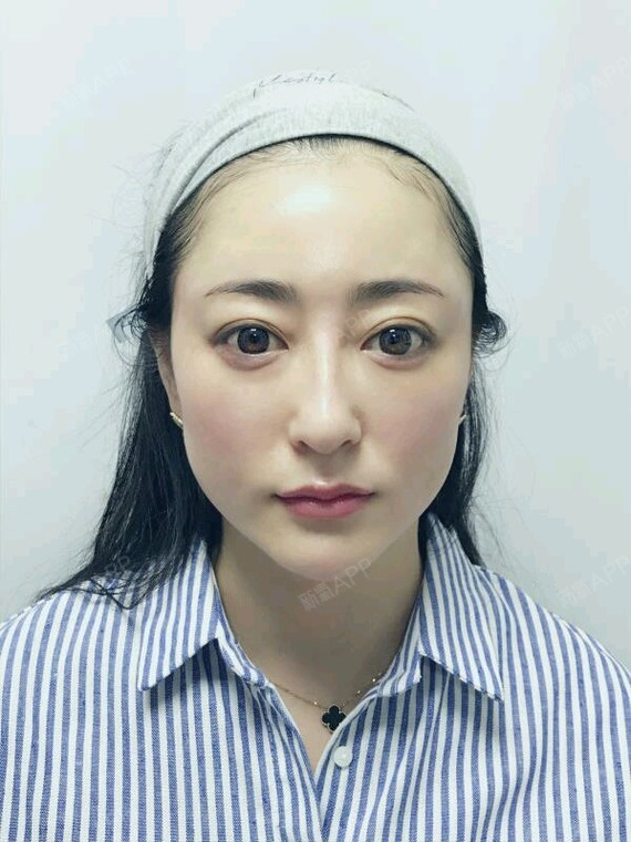 涛涛姐玻尿酸丰太阳穴第0天美丽日记