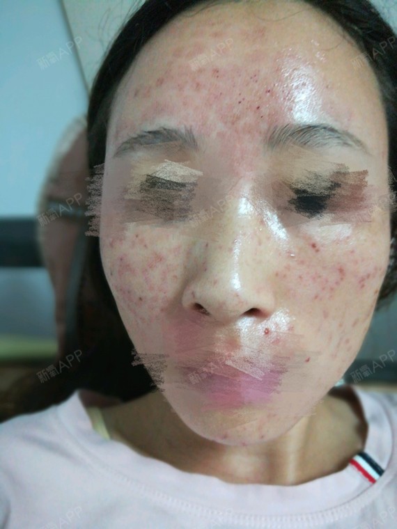 激光祛斑项目术后第1天