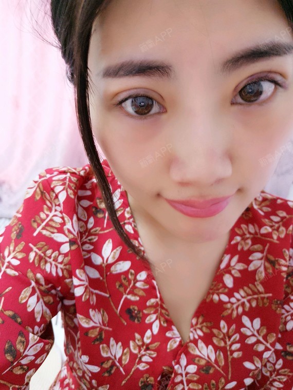 27号做的平行双眼皮今天是第七天,眼睛形状挺满意的_圈子-新氧美容