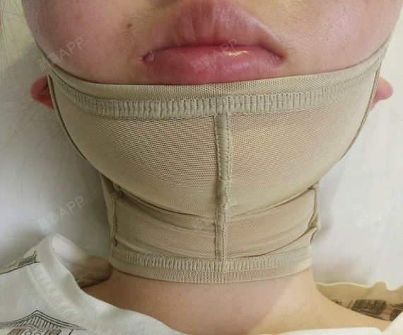 哈尔滨面部吸脂好不好_效果图_染染的夏天面部吸脂术后第2天_新氧美容