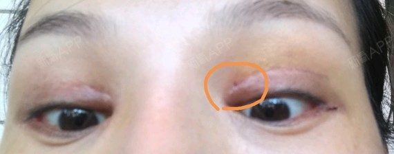 切开双眼皮开内外眼角下眼下至十天了