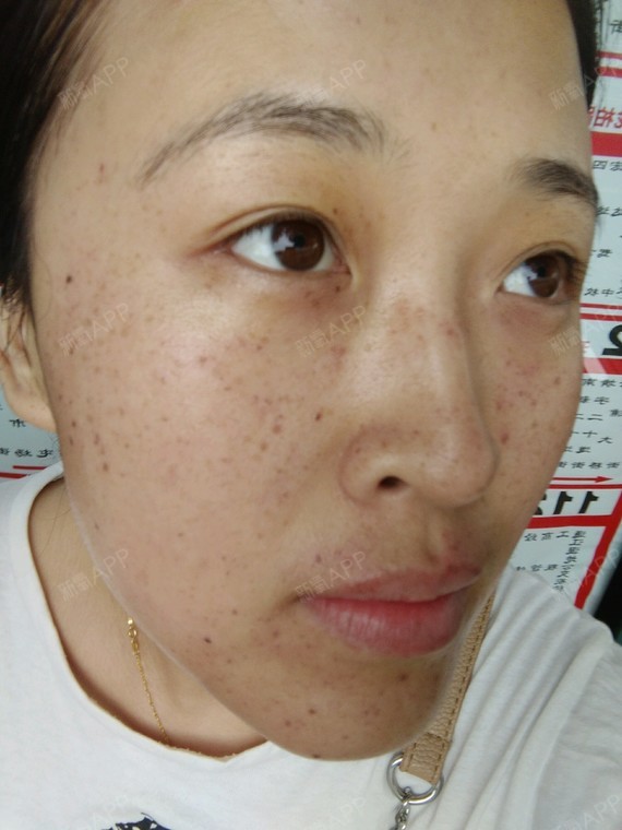 哈尔滨激光祛斑好不好_效果图_奇可爱激光祛斑术后第0天_新氧美容整形