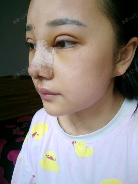 a欣欣13162029070鼻中隔软骨隆鼻第3天美丽日记