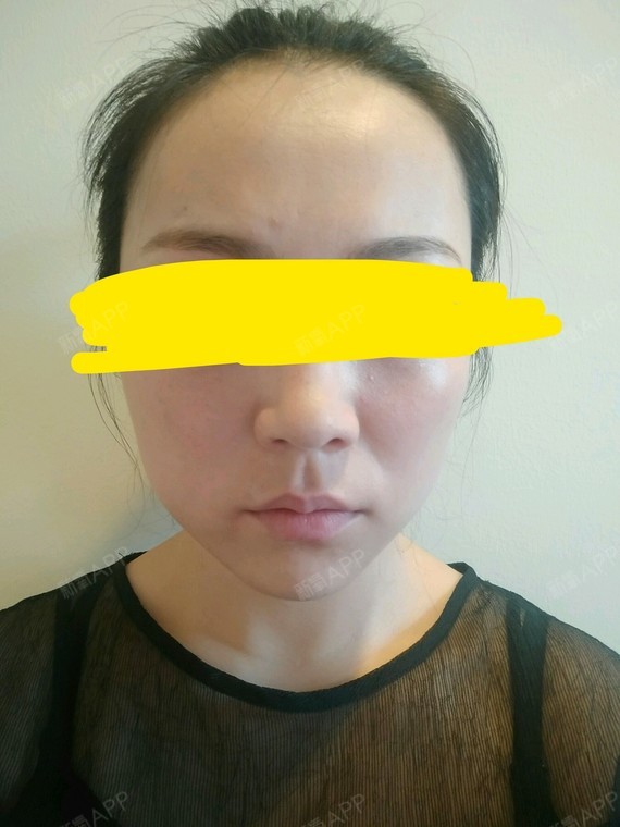 轮廓针多久打一次_轮廓针打完注意事项_轮廓针打几次才能永久定型