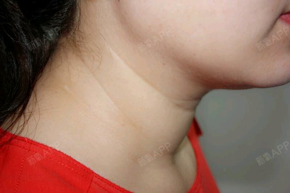 我人其实不胖,但是脖子上肉多,然后松弛下来后就好多_圈子-新氧美容
