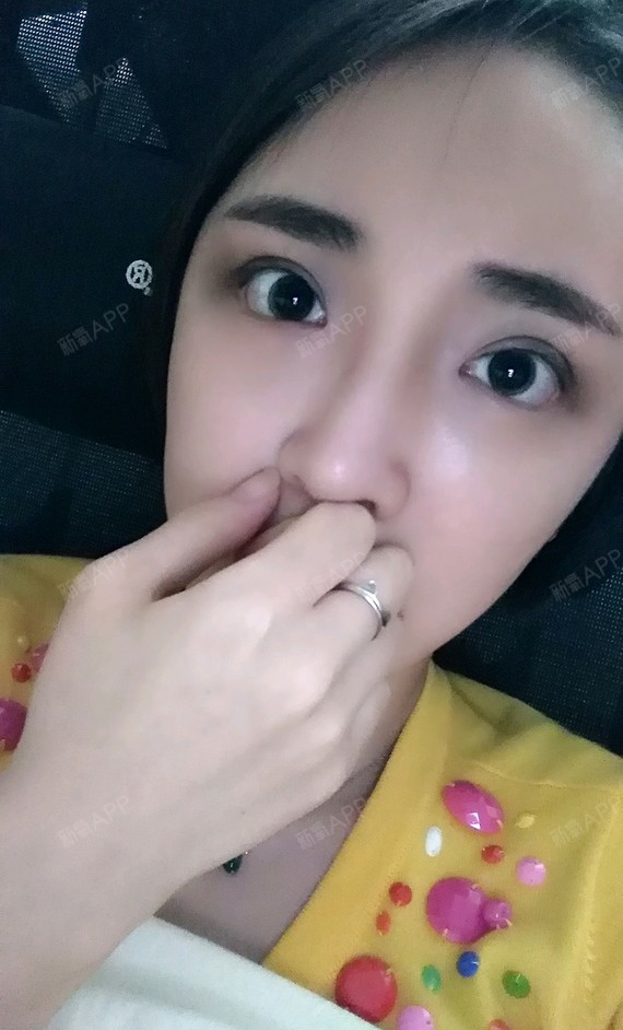 新氧- 蛋卷其实是蛋挞 | 眼部 | 开眼角 | 开外眼角 | 术后当自强