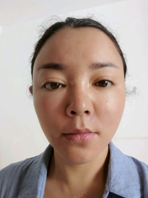 玻尿酸丰苹果肌好不好_效果图_氧气eqb76fd玻尿酸丰苹果肌术后第1天