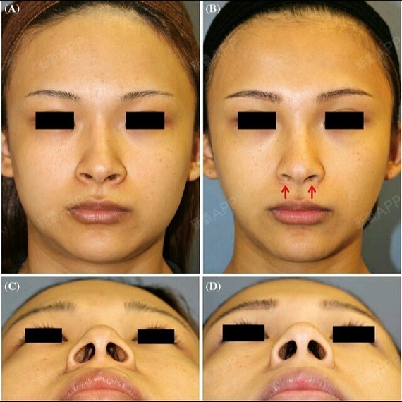 【武汉茜韵】避免手术痕迹的鼻翼缩小新方法