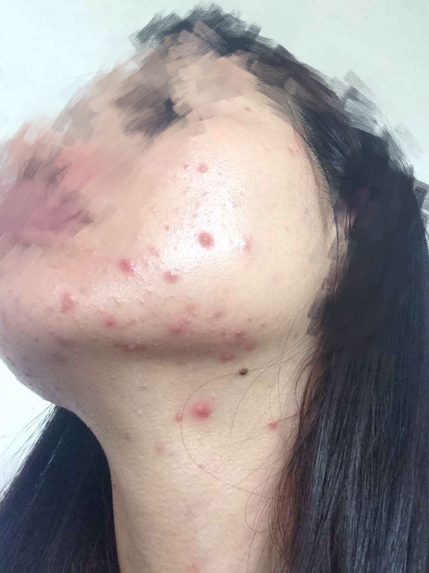 点阵激光