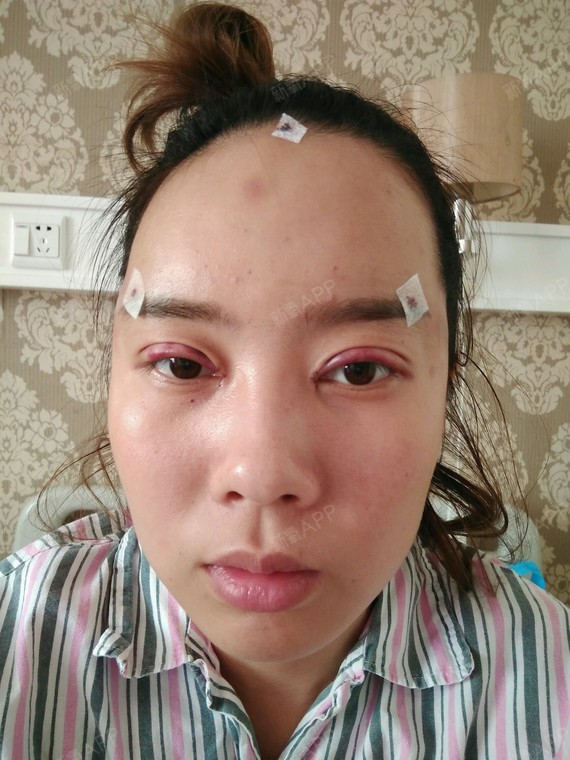 温州开内眼角好不好_效果图_氧气zlsb5d4开内眼角术后第1天_新氧美容