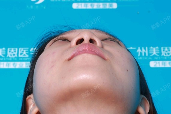 鼻子歪斜是隆鼻术后常见症_圈子-新氧美容整形