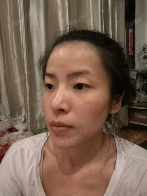 从小额头凹陷,皱眉就有一个坑,相当影响美观 夫妻宫