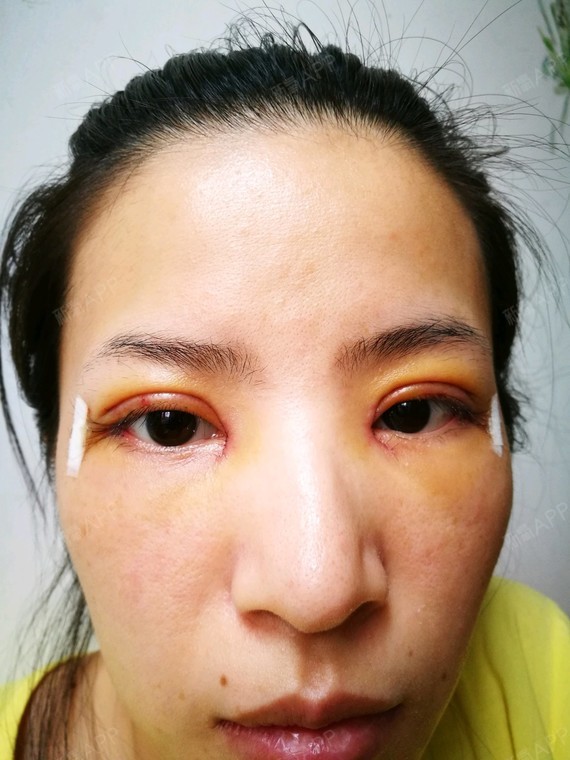 新氧- 回本回 | 眼部 | 开眼角 | 双眼皮 | 开内眼角 | 开外眼角