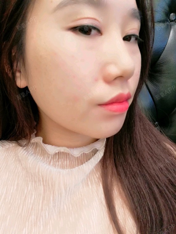 今天打了瘦脸针超级紧张,还好不是很疼可以接受等待效果
